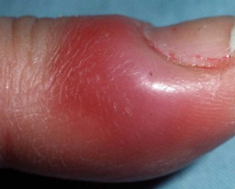 Microbial nail infection