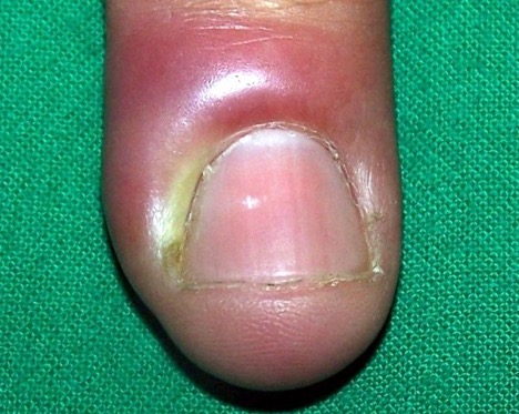 Microbial nail infection