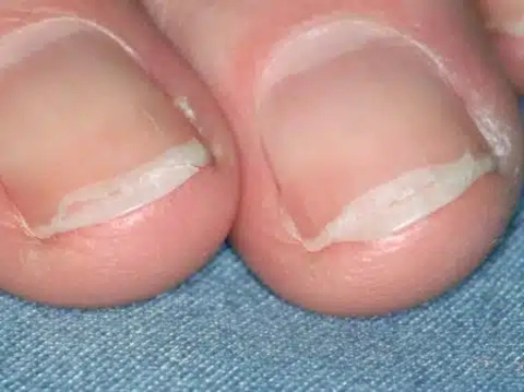 brittle nails