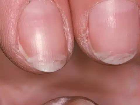 تقویت-کننده-ناخن-پلاس-رسپینا fragile nails