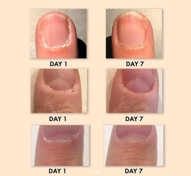 cuticle treatment2