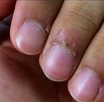 dry cuticle rospina 2