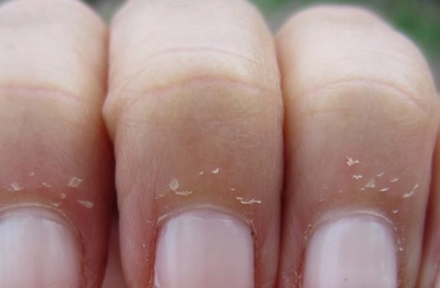dry cuticle rospina