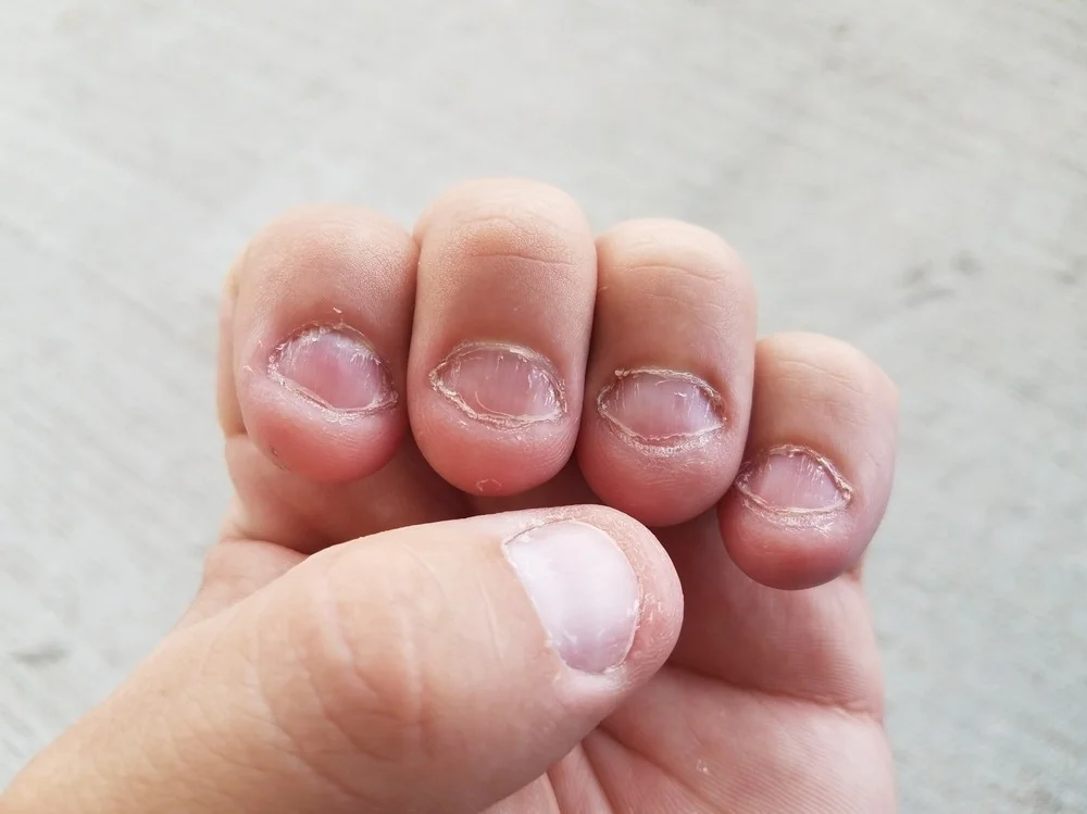 nail bite damages
