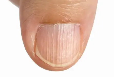 تقویت-کننده-ناخن-پلاس-رسپینا ridged nails
